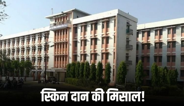 रीवा मेडिकल कॉलेज में विंध्य क्षेत्र का पहला स्किन डोनेशन, जले मरीजों को मिलेगा नया जीवन