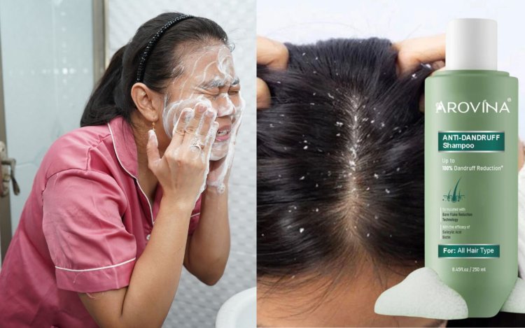 क्या एंटी-डैंड्रफ शैम्पू से ठीक हो सकते हैं Acne? जानिए सच
