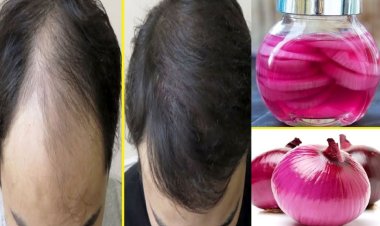 Onion Oil : बारिश में बालों का झड़ना रोकें! जावेद हबीब का प्याज रस वाला घरेलू नुस्खा, तेल से बेहतर है जूस?
