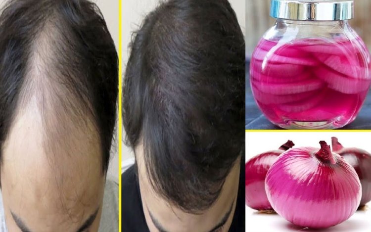 Onion Oil : बारिश में बालों का झड़ना रोकें! जावेद हबीब का प्याज रस वाला घरेलू नुस्खा, तेल से बेहतर है जूस?
